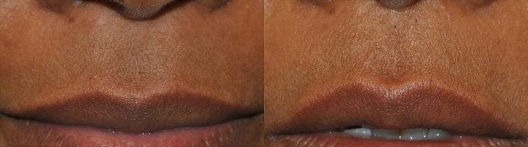 Lip Flip before and after oblique - 3