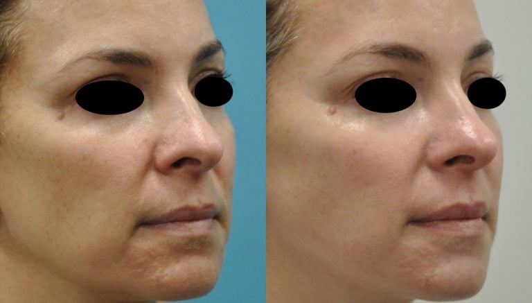 Forma and KIRWAN Brightening Cream before and after