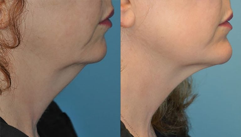 After two Kybella treatments and chin augmentation