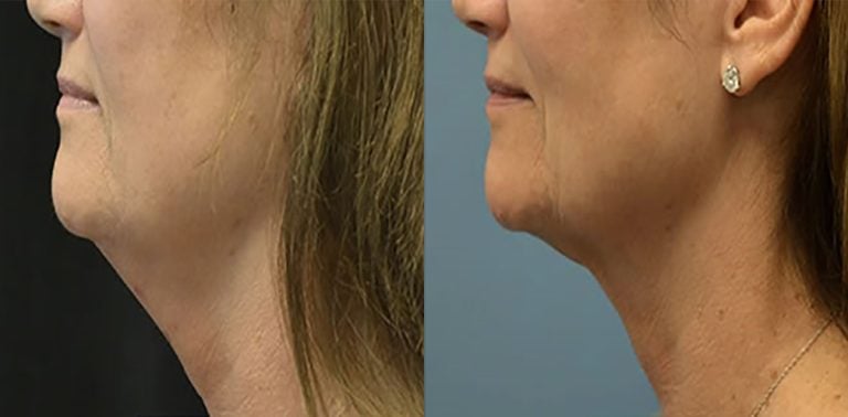 Kybella one treatment 80 mgm treatment 4 months later neck only