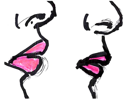 Lip procedure