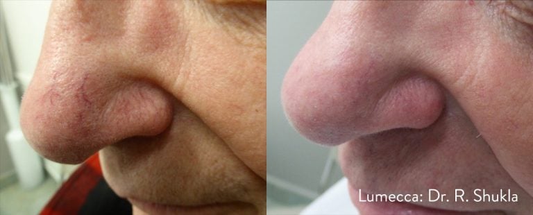 Lumecca Nose - scaled