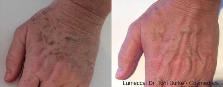 Lumecca - Hands - 2