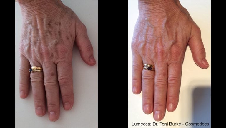 Lumecca - Hands - Image 2