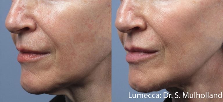 Lumeca - Face - 3