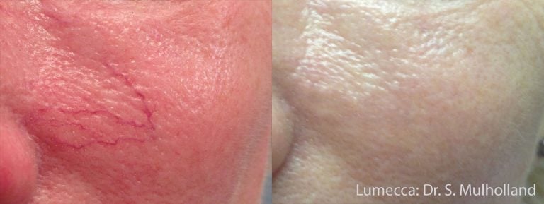 Lumecca - Cheeks - 4
