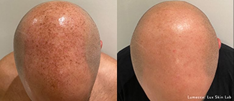 Scalp freckles