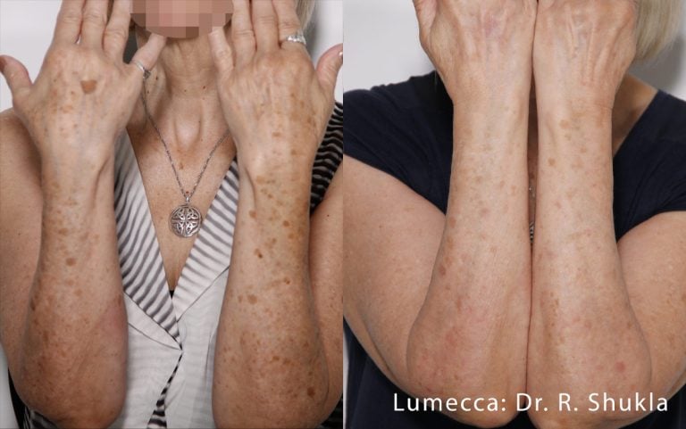 Lumecca Arms - scaled