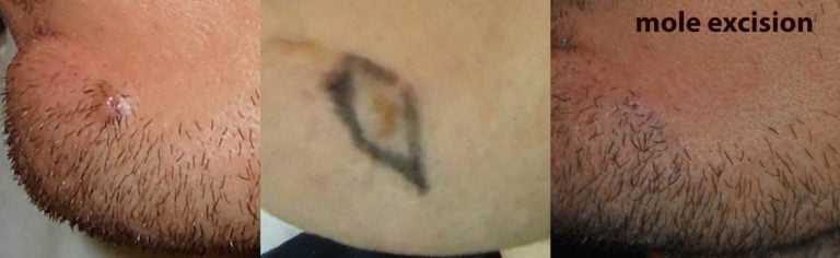 Mole excision