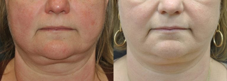 55-year-old 3 months after Morpheus Body to lower face, jawline and neck