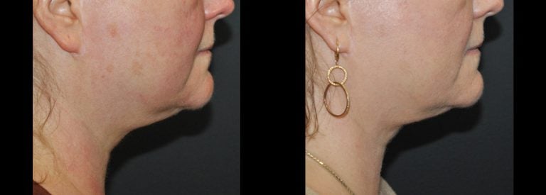 55-year-old 3 months after Morpheus Body to lower face, jawline and neck