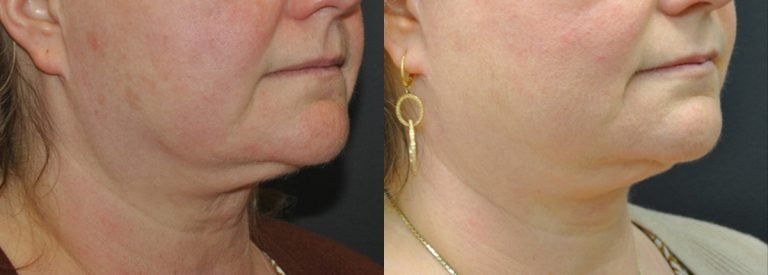 55-year-old 3 months after Morpheus Body to lower face, jawline and neck right oblique