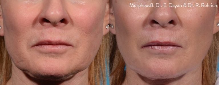 Morpheus8 - Perioral: Dr. E. Dayan & Dr. R. Rohrich