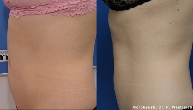 Morpheus8_Abdomen-Side: Dr. R. Westreich