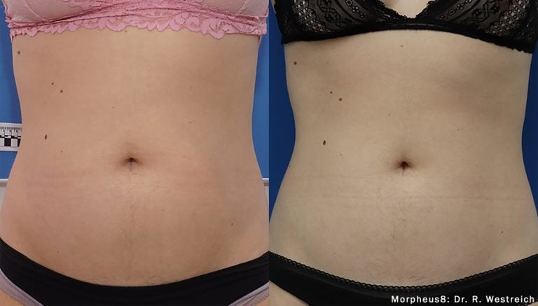 Morpheus8_Abdomen: Dr. R. Westreich