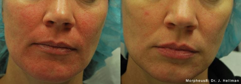 Morpheus8 - Acne 1Tx Front - scaled
