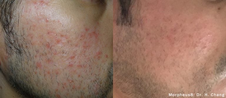 Morpheus8 - Acne - 12