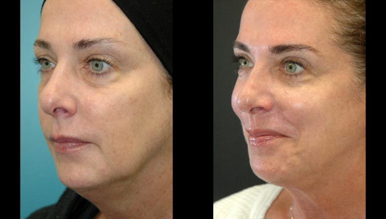 Facetite & morpheus. Face & neck 5 months oblique