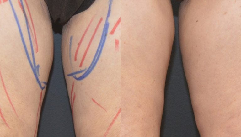 64-year-old bilateral liposuction inner & Morpheus Body 7 months