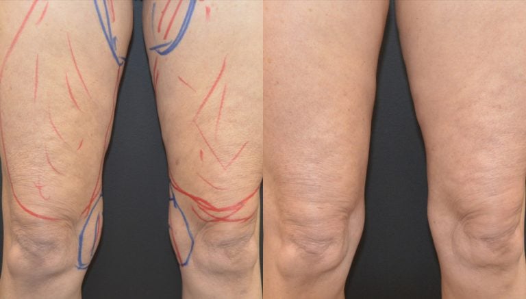 64-year-old bilateral liposuction inner thighs & knees and Morpheus Body thigh 7 months