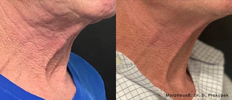 Morpheus8 - Neck Jaw - 17