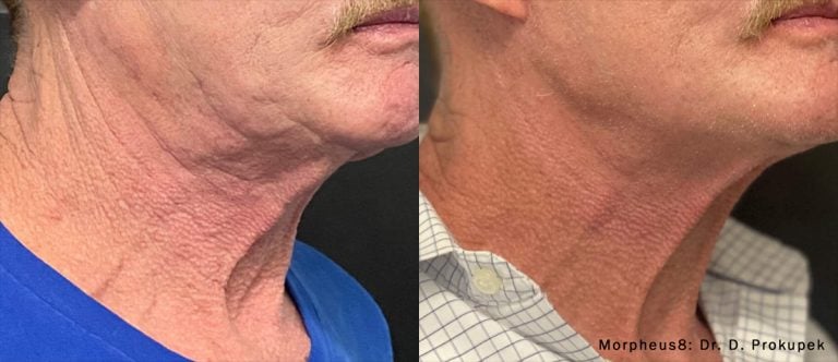 Morpheus8 - Neck Jaw Line - 17