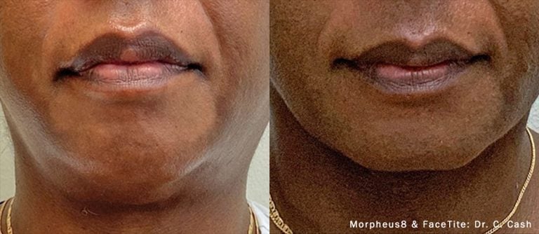 Morpheus8 FaceTite Front Chin & Neck