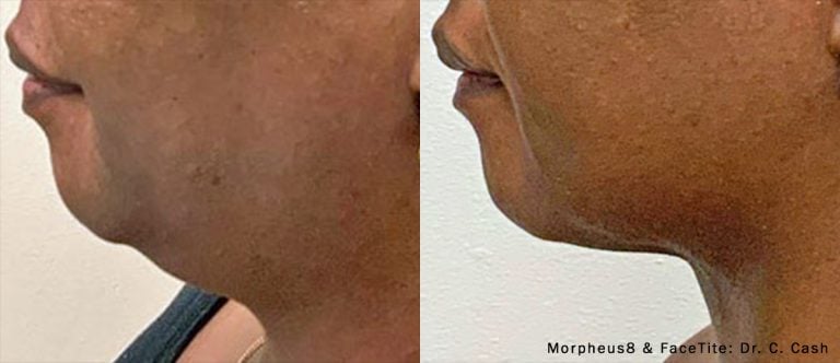 Morpheus8 FaceTite left profile chin & neck
