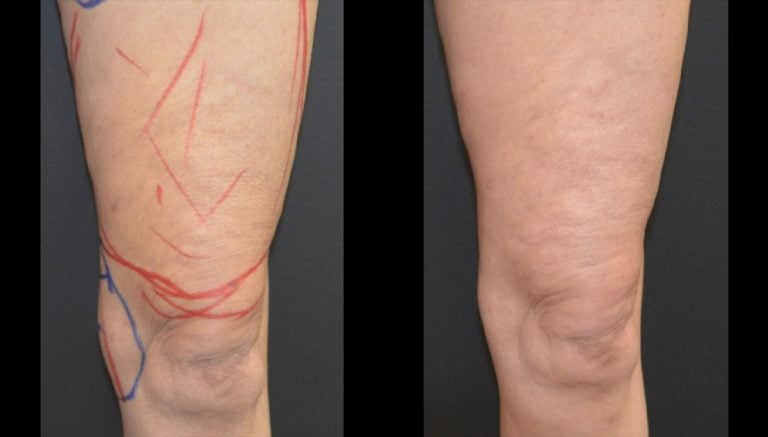 64-year-old liposuction inner thighs and knees and Morpheus Body thigh 7 months left leg