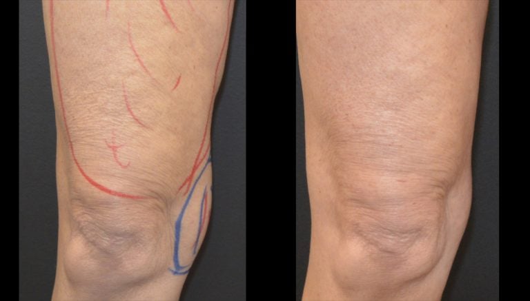 64-year-old liposuction inner thighs and knees and Morpheus Body thigh 7 months right leg