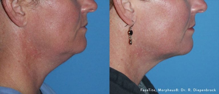 Face right profile - Morpheus8