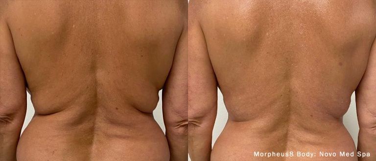 Morpheus8 - Body - Back - 1
