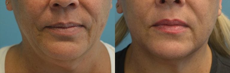 Morpheus8, Facetite peri-oral and neck front