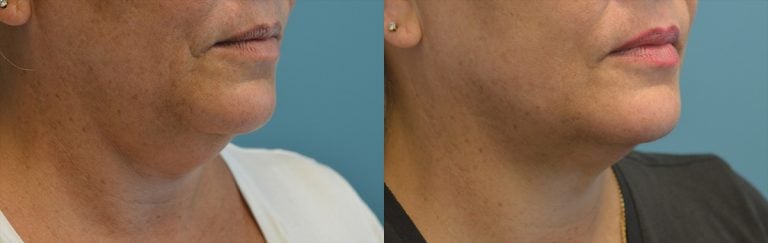 Morpheus8, Facetite peri-oral & neck with liposuction neck, oblique