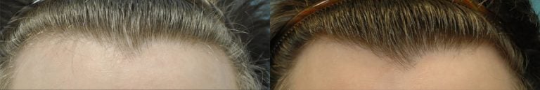 Forehead hairline thinning, improved after 3 PRP treatments