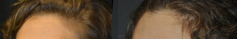 Hairline temporal recession improved after 3 PRP treatments