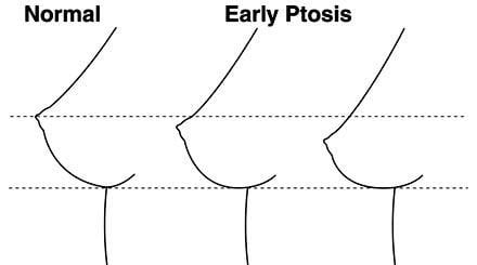 Figure 1 – Kirwan Classification Stages A-F