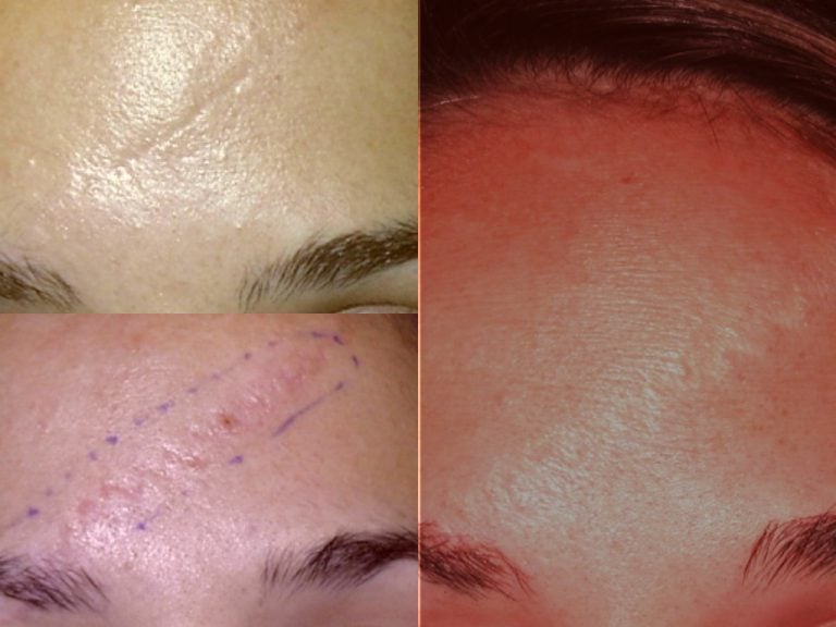 Scar revision W-Plasty initial healing