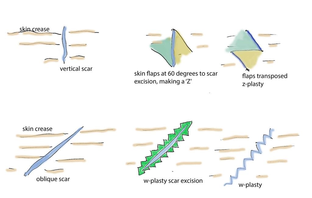 Z-Plasty and W-Plasty Scar Revision