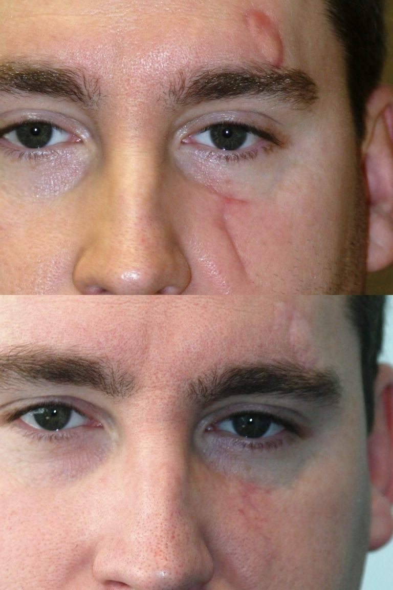Z-Plasty scar revision 6 months after surgery