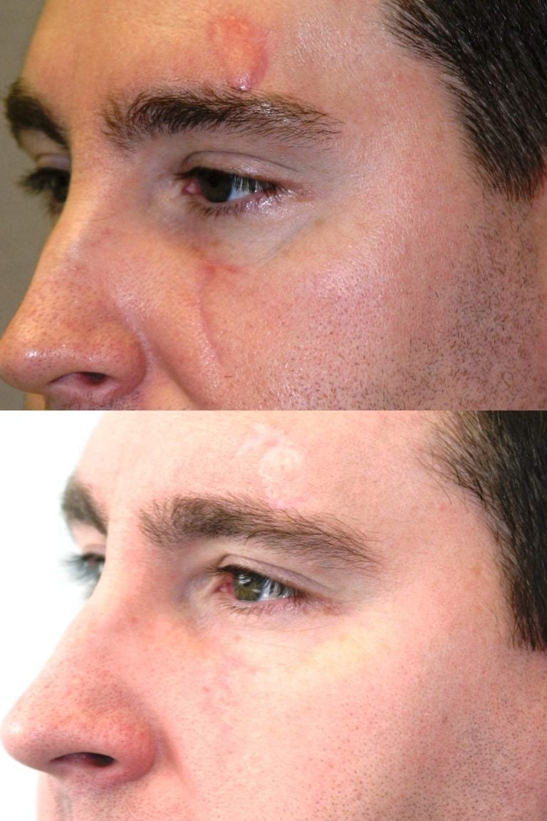 Z-plasty scar revision 6 months after surgery, oblique view