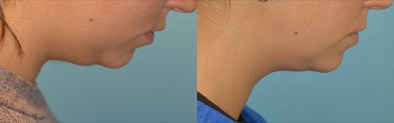 22-year-old Accutite 5 months, chin down
