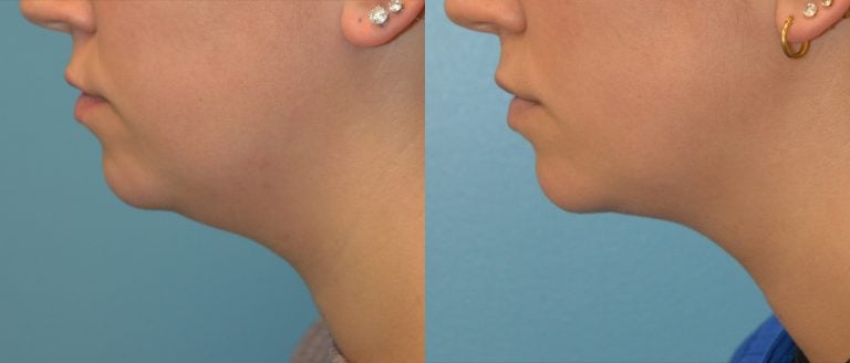 22-year-old Accutite 5 months, left side