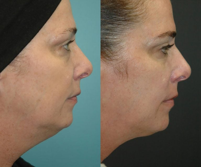 Facetite & morpheus 5 months side
