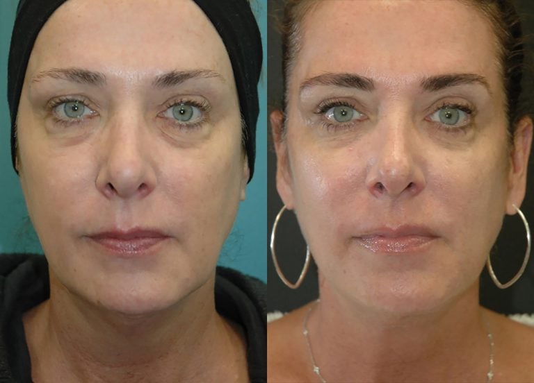 Facetite & morpheus 5 months front