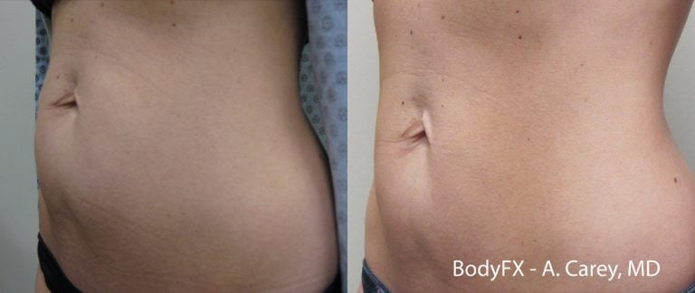 BodyFX - Case 1