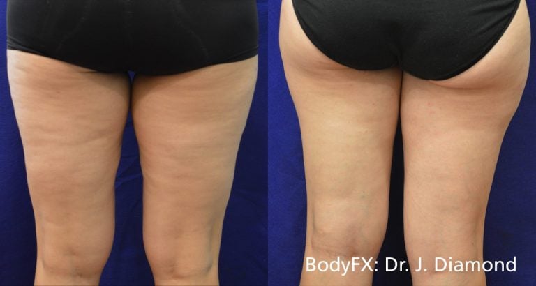 BodyFX – Scaled - Case 12