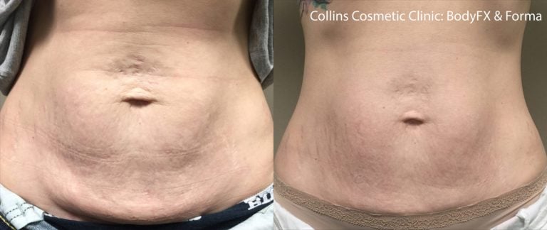 BodyFX Forma abdomen - 2