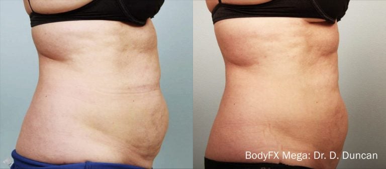 BodyFX Mega - 4