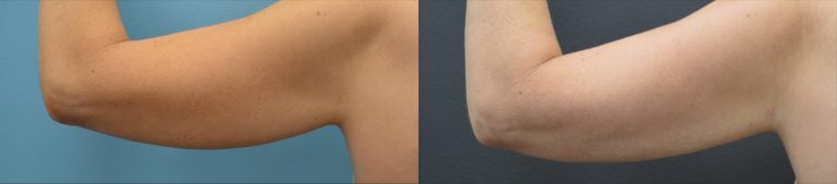 49-year-old, BodyTite and liposuction to arms, left arm, back, 5 months